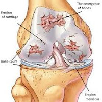 Cara Mengobati Pengapuran Sendi Lutut