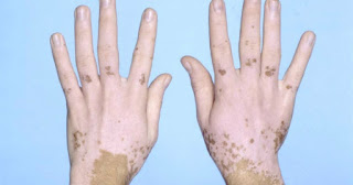 Tratamiento Para El Vitiligo