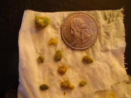 green and yellow gallstones