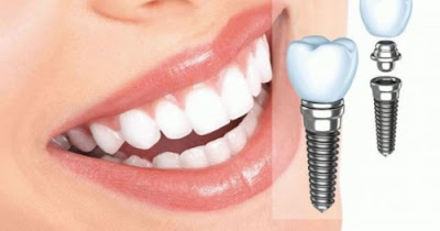 Cấy ghép implant răng hàm giá bao nhiêu? 2