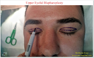 Blepharoplasty,Droopy eyelid surgery,Upper eyelid surgery, in Istanbul, Cost