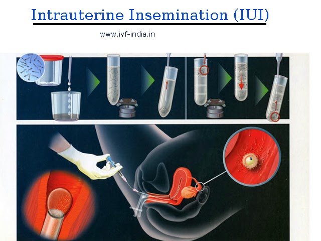 http://www.ivf-india.in/services/intrauterine-insemination-iui/