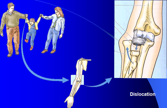 Distal Radioulnar Joint. Distal radioulnar joint: