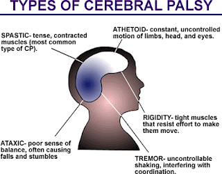 Nursing Care Plan for Cerebral Palsy (CP) 