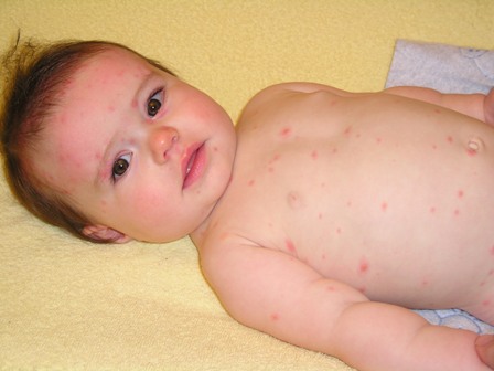 chicken pox infants