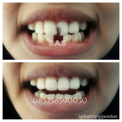 Foto hasil perbaikan gigi depan keropos hitam dan pasang gigi tiruan sas ahli gigi pati