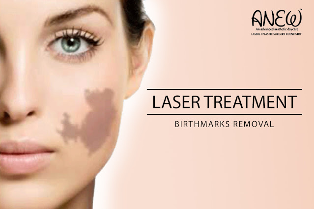 Laser treatment for birthmarks removal in Bangalore