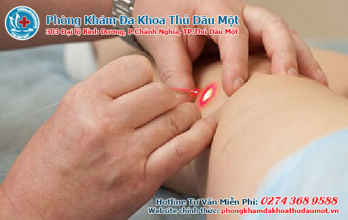 Những phương pháp đốt sùi mào gà phổ biến hiện nay?