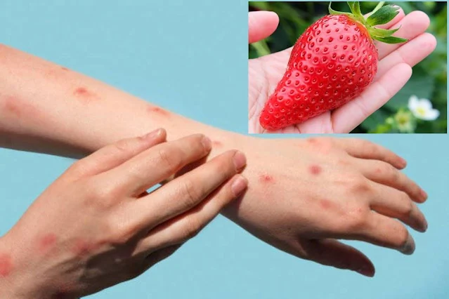 Signs & Symptoms: How to Manage and Prevent Allergic Reactions to Strawberries