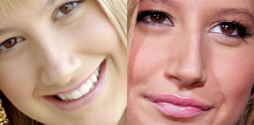 nose job (rhinoplasty),