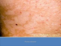 Pitiriasis versicolor