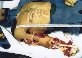 shark bite victims are not tiger shark attacking. shark bite victims are not