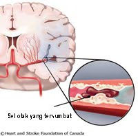 Waspadai Gejala Stroke 