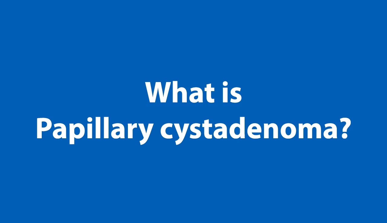 Papillary Cystadenoma