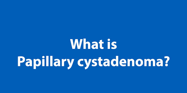 What is Papillary Cystadenoma?