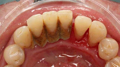 Cao răng cấp độ 3 là gì?