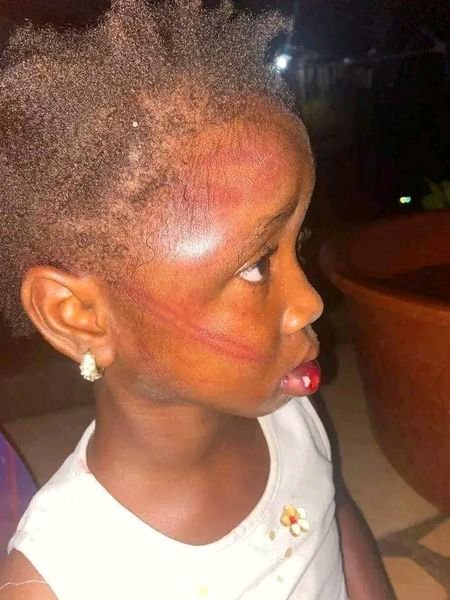 A 5-Year-Old Girl, Starving and Abused by Her Aunt, After Attempting to Get Food from a Pot