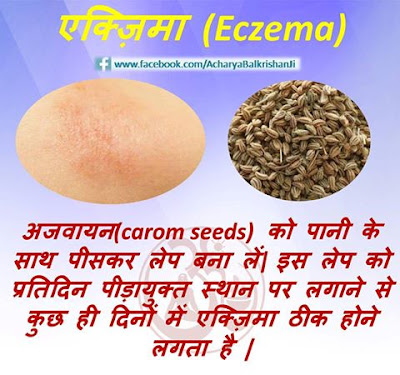 Home Remedy For Eczema / एक्जिमा का घरेलु इलाज