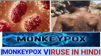 Monkey pox in Hindi,   Monkey pox virus in Hindi