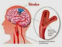 penyakit stroke, stroke bisa sembuh total