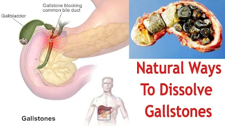 Effective Way To Dissolve Gallstones Naturally: Natural Gallbladder Cleanse