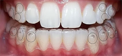 Những khó khăn thường gặp khi đeo khay niềng Invisalign