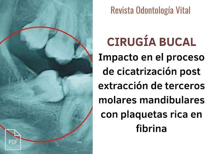 PDF: Impacto en el proceso de cicatrización post extracción de terceros molares mandibulares con plaquetas rica en fibrina: Revisión de Literatura