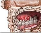 Cara Atasi Gusi Bengkak (Swollen Gum)