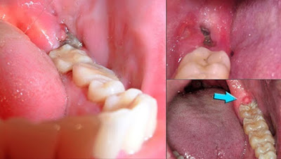 Cách điều trị viêm lợi trùm răng số 8