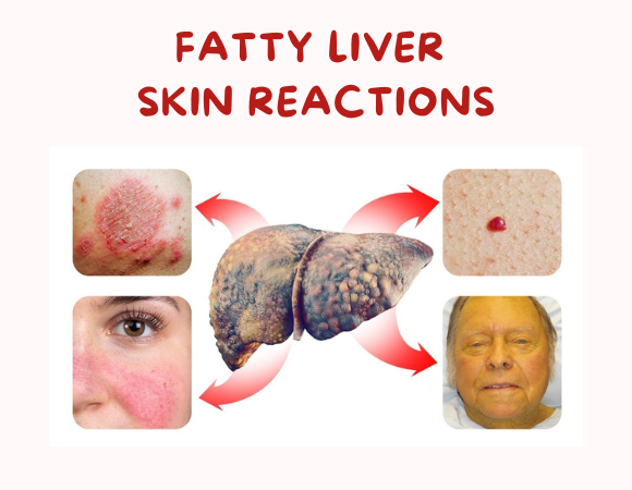 Fatty liver signs & symptoms