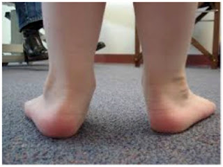 orthopedic problem in children