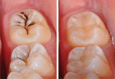 Bọc răng sứ ở nha khoa nào hiệu quả?
