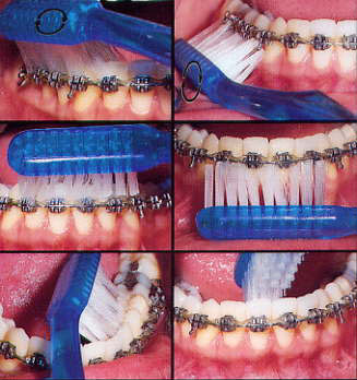 White Spots On Teeth After Braces Removed Images &amp; Pictures - Becuo