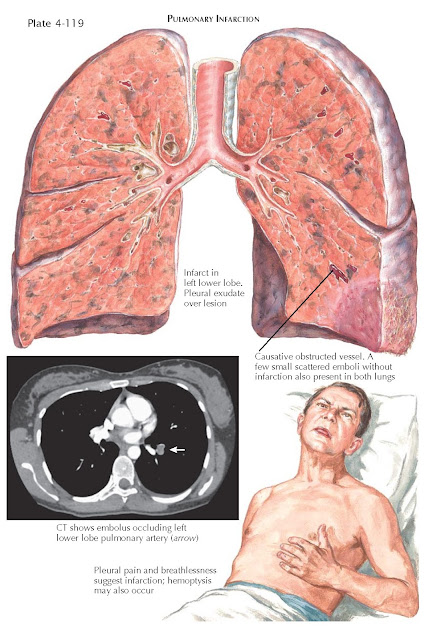 PULMONARY INFARCTION