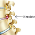 Herniated disc: available surgical treatments (discectomy)