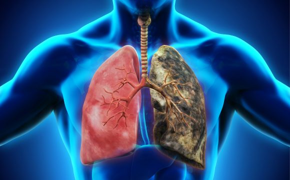 Treatment and Prognosis for Stage 4 Lung Cancer