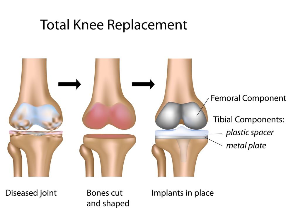 knee replacement surgery Ghaziabad Delhi NCR