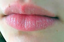 labios agrietados 