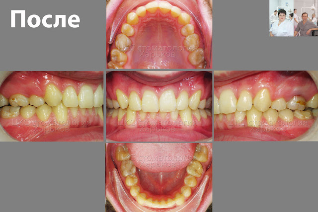 Результат ортодонтического лечения