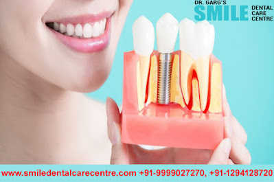 best dental implant in Faridabad