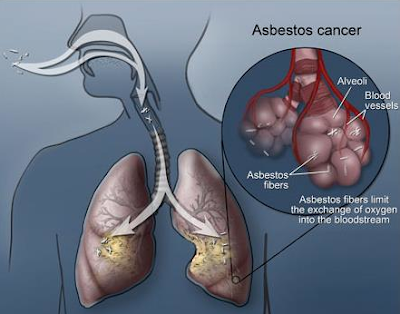 What Is Asbestos and How Does It Cause Cancer