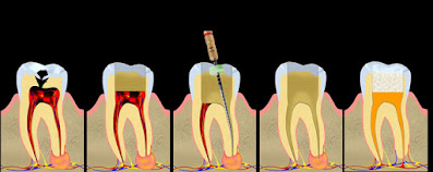 tratamiento de canal conducto endodoncia root canal treatment