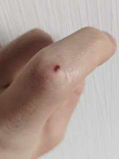 指の怪我画像