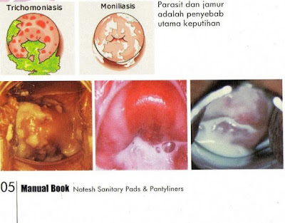 Cara Mengobati Keputihan Akibat Parasit Trichomonas