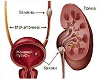 изменение показателей мочи при мочекаменной болезни