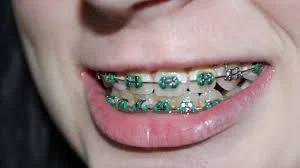 braces in dubai