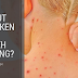 Parut Chicken Pox Boleh Hilang Dengan Cepat? Anda Boleh Amalkan Sendiri Nanti