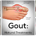 TOTOONG DAHILAN NG GOUT AT NATURAL NA LUNAS NITO
