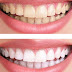 Tẩy trắng răng được thực hiện như thế nào?