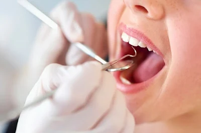 Nguyên nhân chảy máy chân răng khi lấy cao răng 